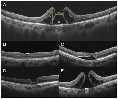 Outcomes of revision surgery for idiopathic macular hole after failed primary vitrectomy